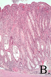 Histologic image of clostridial enteritis.
