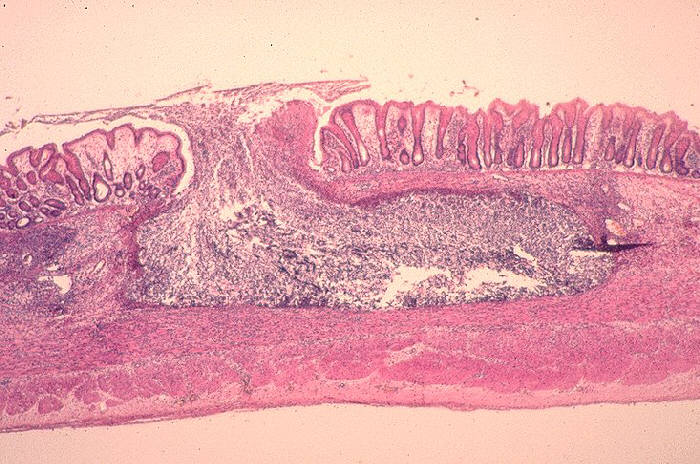 flask-shaped ulcer due to Entamoeba histolytica