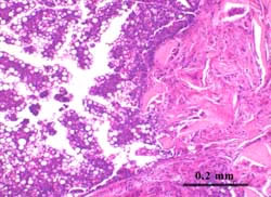 Adenosquamous carcinoma