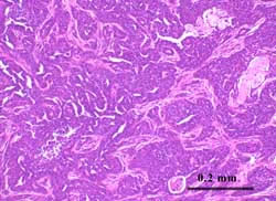 Mammary tumor induced by polyoma middle T