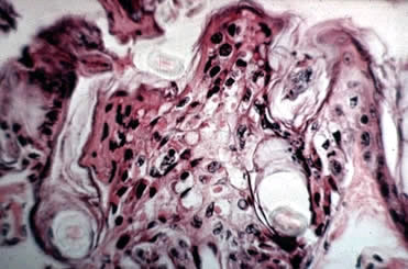 Intracytoplasmic inclusions caused by ectromelia virus infection in mouse skin.