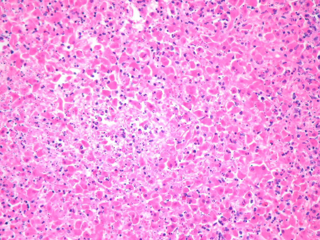 Tyzzer's disease, H&E, liver