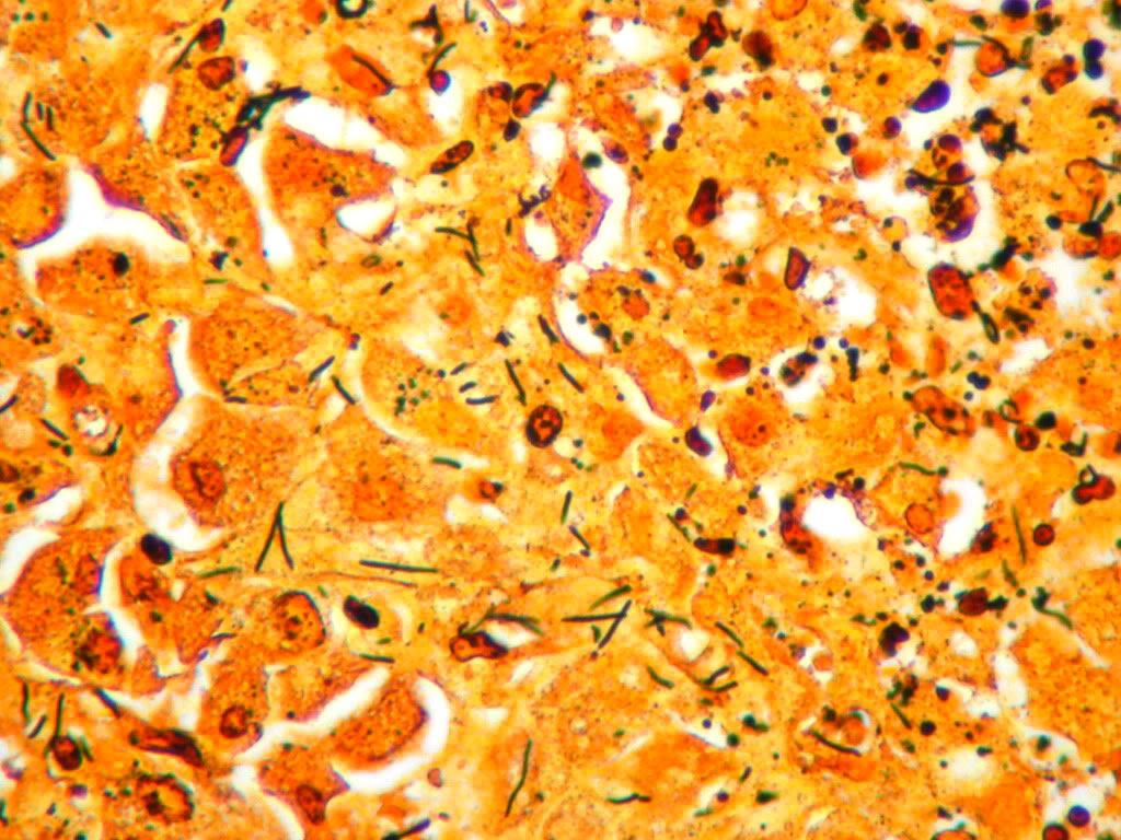 Tyzzer's disease, silver stain, liver