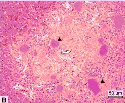 Yersinia in the liver